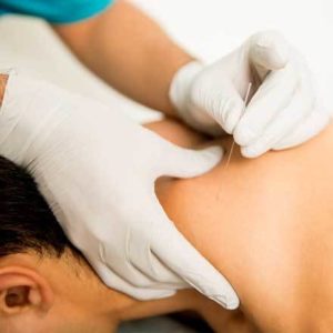 dry-needling ability physiotherapy