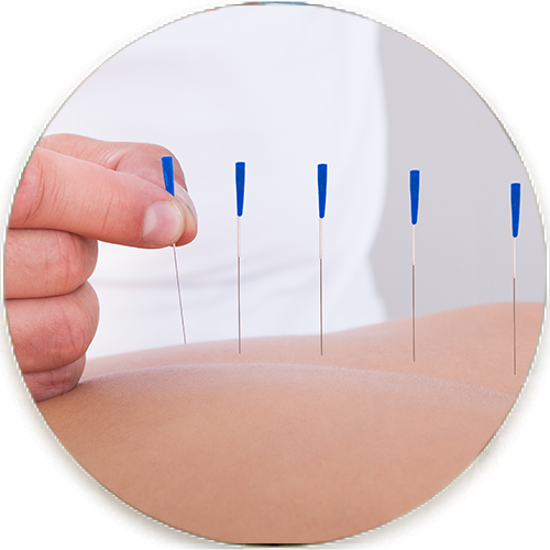 dry-needling-ability-physiotherapy