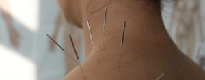 acupuncture